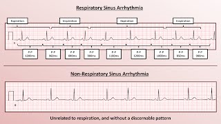 Advanced EKGs  Sinus Node Dysfunction