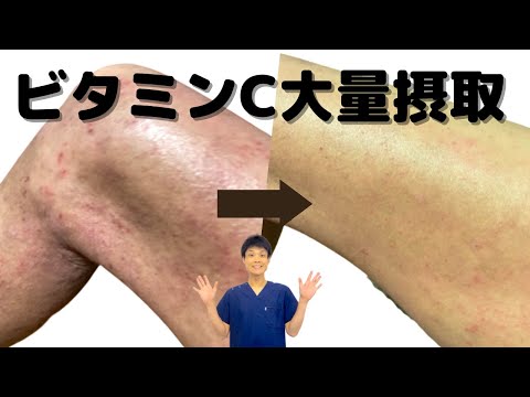 【アトピーの治し方】ビタミンCを飲むだけで、アトピーの肌荒れが改善する！
