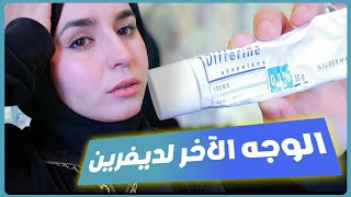 الوجه الآخر لكريم دفيرين سيدمر بشرتكم 😤 || سلبيات و مخاطر استعمال دفيرين || defferin