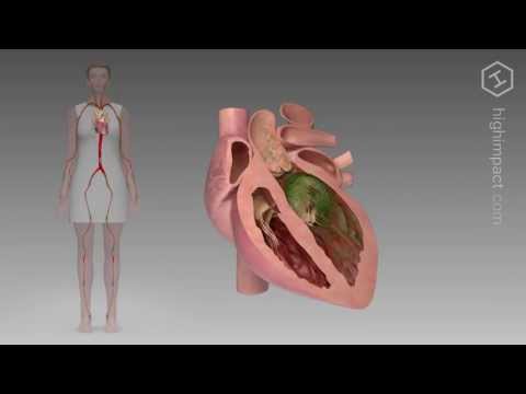 Video: Endokarditis: Risikofaktorer, Symptomer Og Diagnose