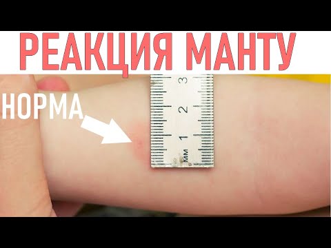 Видео: За какво прави теста Манту?