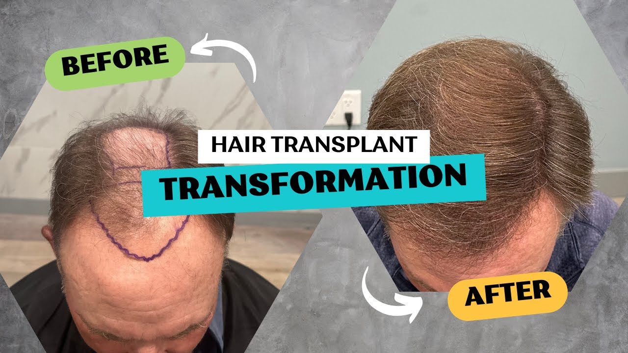 5,700 FUE GIGASESSION! Amazing hair transplant result after extracting 5,700 grafts!