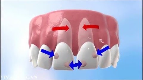 Tìm hiểu quy trình niềng răng trong suốt Invisalign
