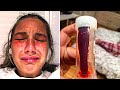 Girl Has Intense Itch Inside Nose - Visits Doctors And Makes Horrifying Discovery