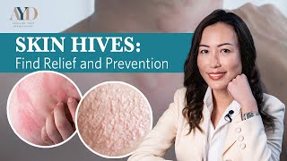 Skin Hives Find Relief And Prevention