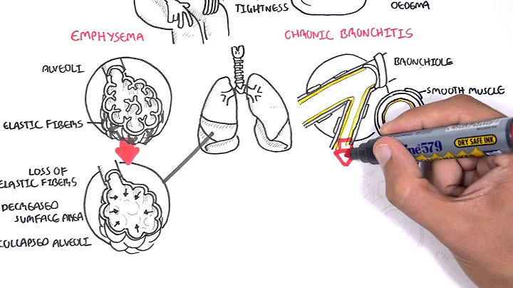 Chronic Obstructive Pulmonary Disease Overview (types, pathology, treatment)