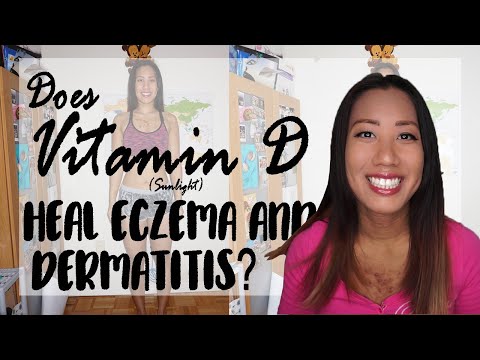DEALING WITH ECZEMA & DERMATITIS | Does Vitamin D (Sunlight) Help?