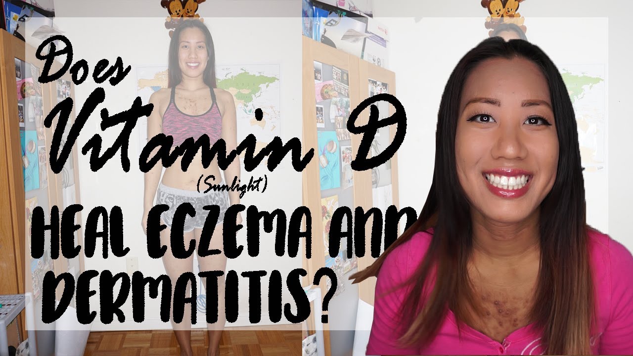 Dealing With Eczema  Dermatitis | Does Vitamin D (Sunlight) Help?