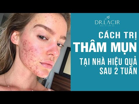 Cách trị thâm mụn tại nhà cho da sáng đẹp chỉ sau 2 tuần