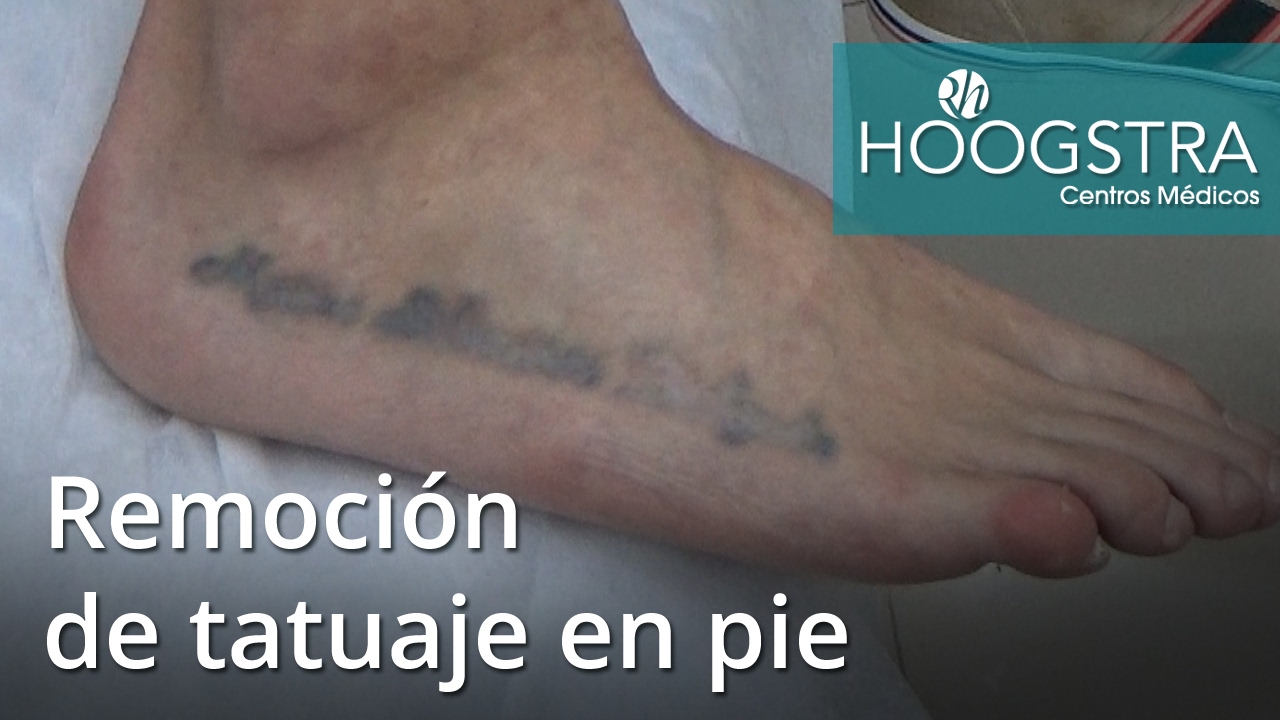 tattoo shops near me Remoción de tatuaje en pie (16170)