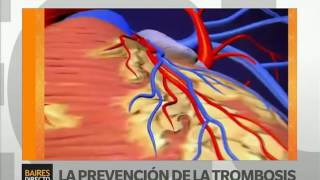 Prevenir la naturalmente como trombosis