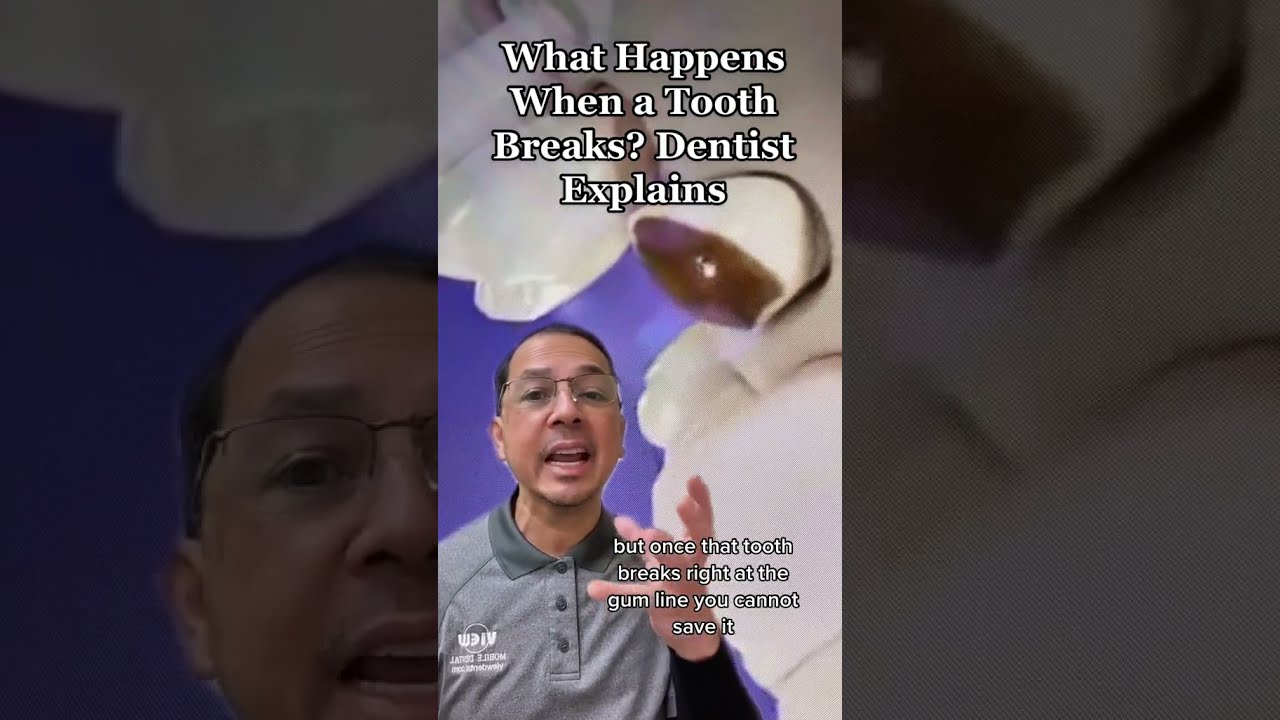 What Happens When A Tooth Fractures Near The Gum Line Extraction View Mobile Dental