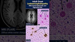 Adult Onset Leukoencephalopathy With Axonal Spheroids and Pigmented Glia (ALSP)