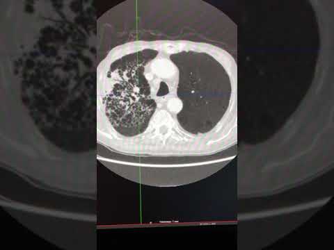 Thoracic Imaging