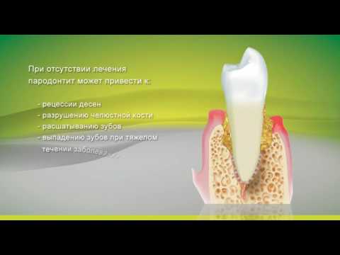 Уменьшение подвижности зубов