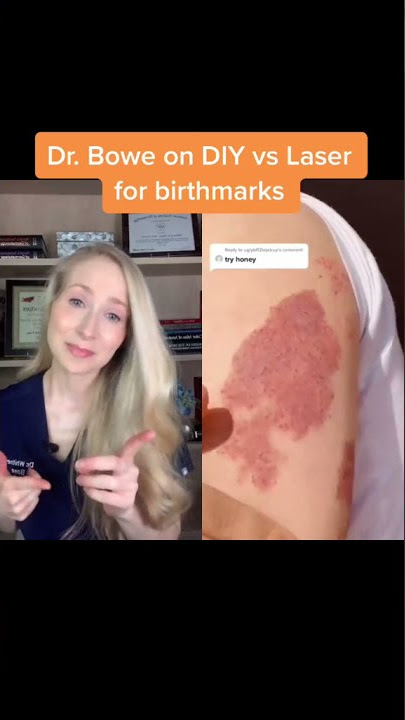 Dermatologist on DIY treatments for birthmarks #Shorts