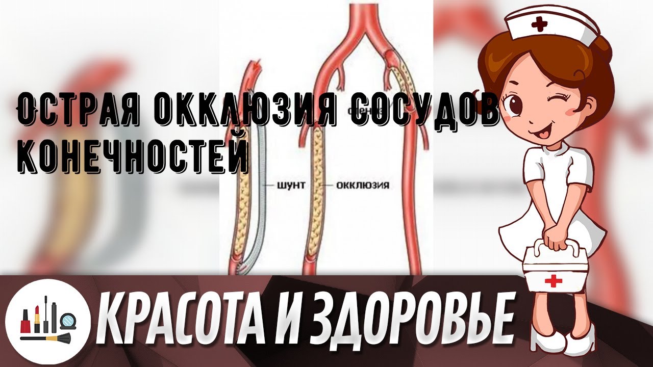 Острая окклюзия сосудов конечностей