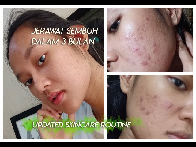 Skincare Sembuhin Jerawat dan Bekasnya! class=