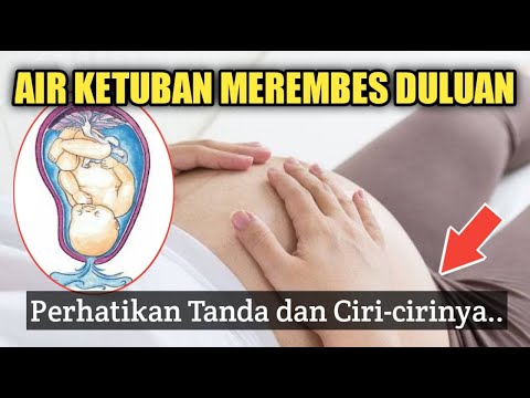 CIRI-CIRI KETUBAN MEREMBES TANPA KONTRAKSI - BUMIL HARUS GIMANA?