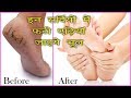 3 दिन में पाएं फटी एड़ियों से छुटकारा | Best Home remedy for Crack heels-...