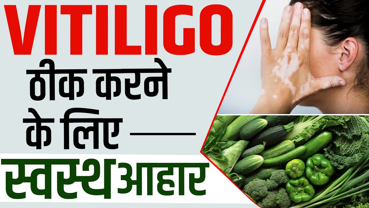 विटिलिगो पेशेंट के लिए स्वस्थ आहार Healthy Foods For Vitiligo
