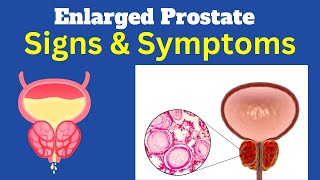 Enlarged Prostate (BPH): Signs and Symptoms, Treatment | Every Man Needs to Know This