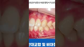 반대교합, 비대칭, 비발치교정 #양산교정치과 #양산치아교정
