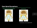 Spinal dysraphisms  dr neil lall  1282022