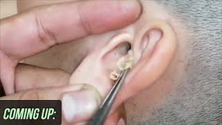 Big Ear Wax Removal! Extreme Extractions!