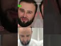 Пересадка волос 223