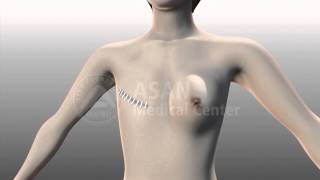 Mastectomy