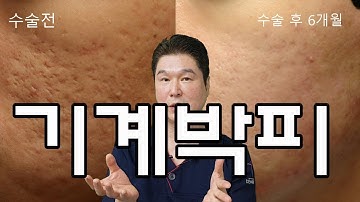 [CN SUB]여드름흉터 제거 (기계박피) 후 6개월동안의  회복과정입니다. 여드름흉터 수술 전후 과정을 확인하시고 기계박피수술 효과를 확인 하시기 바랍니다