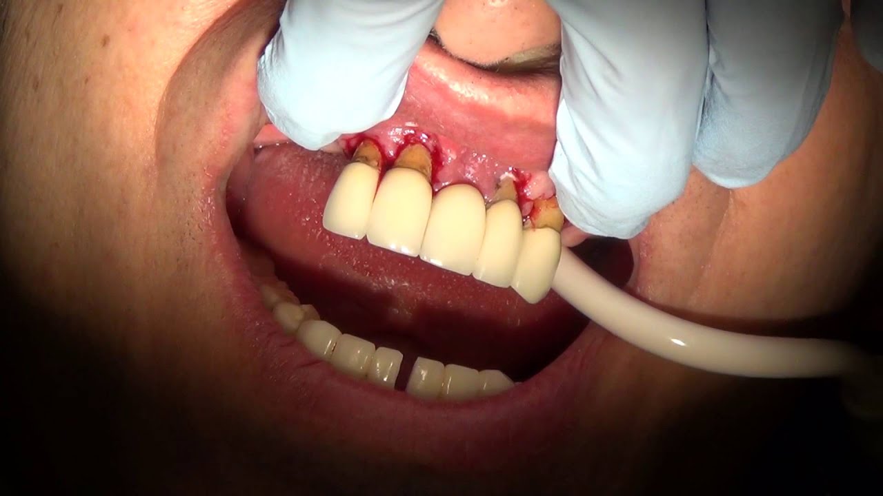 Removal of multiple teeth due to advanced periodontal disease. - YouTube