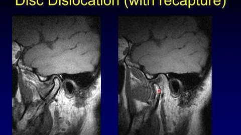 Temporomandibular Joint 1