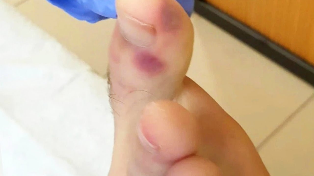 Doctors discover 'COVID toes,' a symptom mainly seen in kids