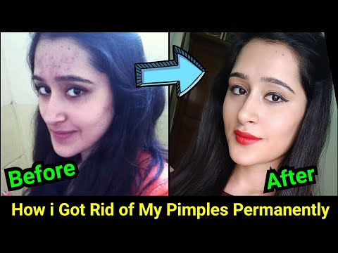 How to Remove Pimples, Acne, Pimple Marks completely | ThatGlamGirl