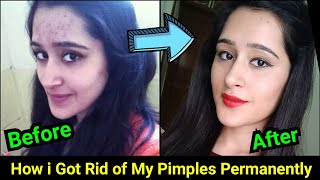 How to Remove Pimples, Acne, Pimple Marks completely | ThatGlamGirl