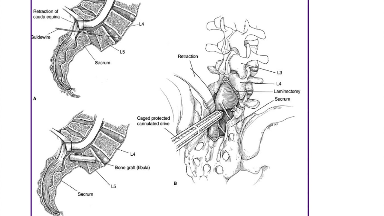 Pediatric Spine ABOS Orthopedic Surgery Board Exam Review YouTube