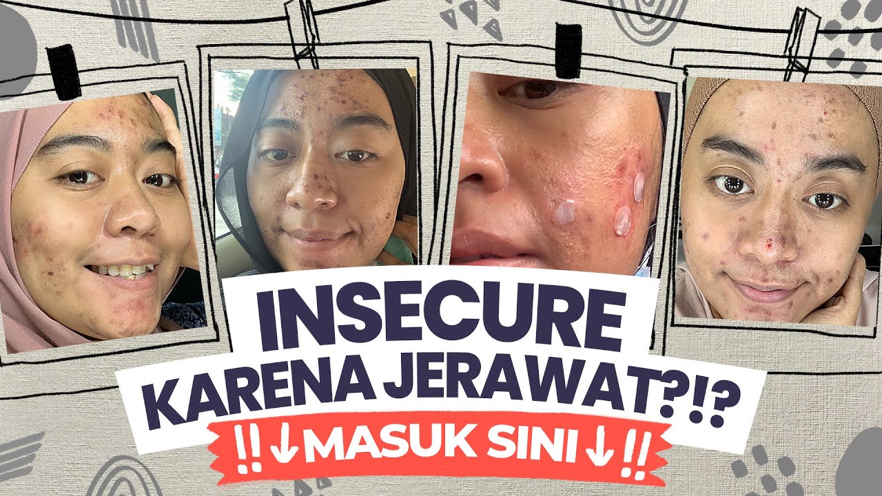 Camkan Ini Biar Ngga Insecure Waktu Jerawatan Motivasi Untuk Pejuang Jerawat Youtube