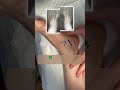 Мои девочки самые лучшие☺️. Спасибо за доверие🤌 Плоскостопие и вальгус. Операция