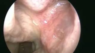 Pulsating Middle Meatus