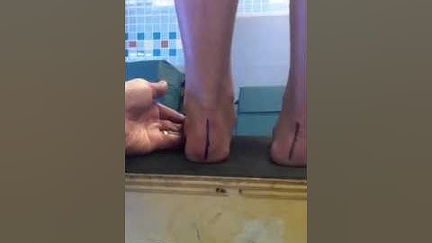 Evaluation of Excessive Supination in Stance