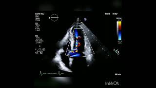 Hypertrophic cardiomyopathy with mid ventricular obstruction