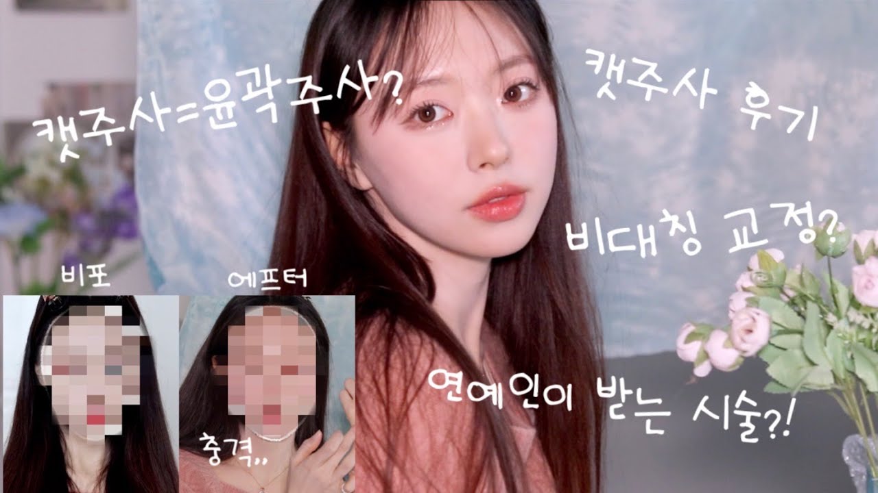 연예인이 받는다는 얼굴형 시술! 캣주사 제가 한번 받아봤는데요~?🤫✌🏻