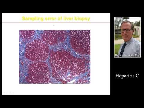 HEPATITIS C (HCV) by Dr. Robert Gish