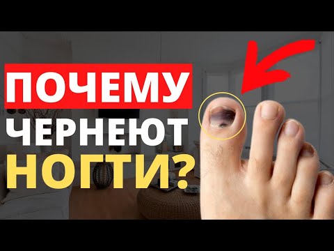 КАК ВЫЛЕЧИТЬ ЧЕРНЫЕ НОГТИ НА НОГАХ? Только 1 Знает, Почему Ногти На Ногах Чернеют!