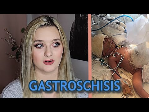 Urodziłam dziecko z wadą rozwojową | Gastroschisis