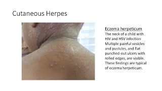 Cutaneous Herpes/Eczema Herpeticum by House Job 63 views 1 month ago 2 minutes, 17 seconds