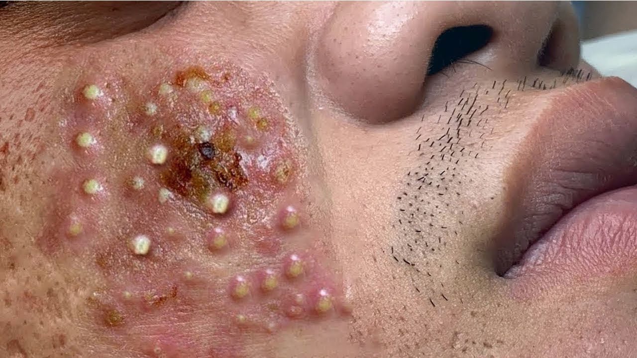 Pimples and Blackhead Removal Videos: A Surprisingly Satisfying Journey!