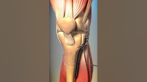Tibial proximal trauma